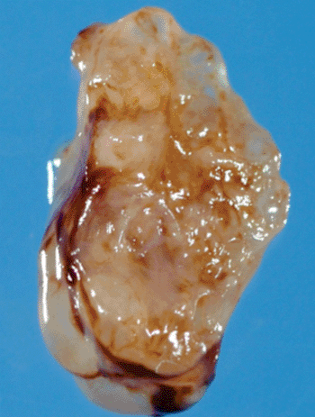 Image: Renal hypodysplasia (Photo courtesy of Sainte-Justine University Hospital).